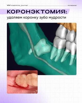 Коронэктомия: спасение нерва без риска.